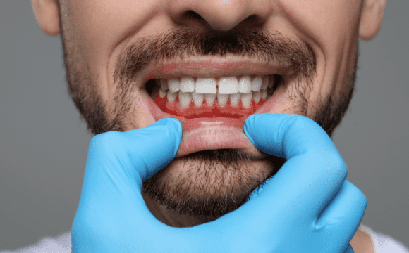 Gingivitis and Periodontal Disease