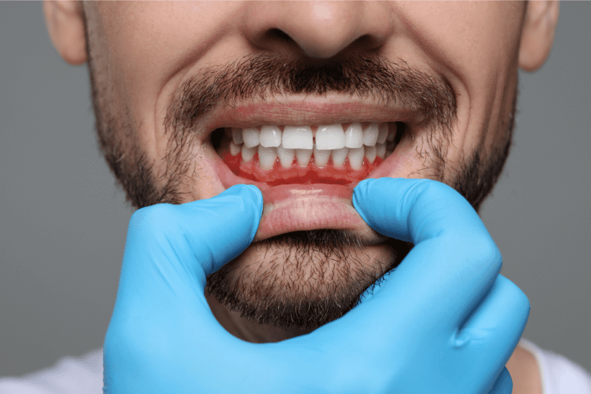 Gingivitis and Periodontal Disease