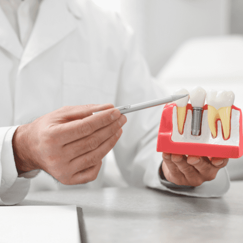 Best Dental Implants