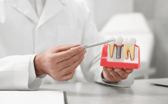 Best Dental Implants